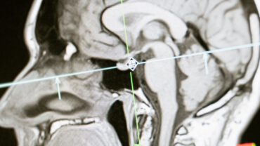 Het Gamma Knife Centrum van het Elisabeth-TweeSteden Ziekenhuis (ETZ) heeft een compleet nieuwe Gamma Knife (afbeelding ter illustratie) voor neurochirurgische behandelingen.